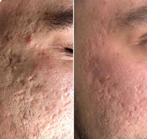 Acne Scars Removal before and after