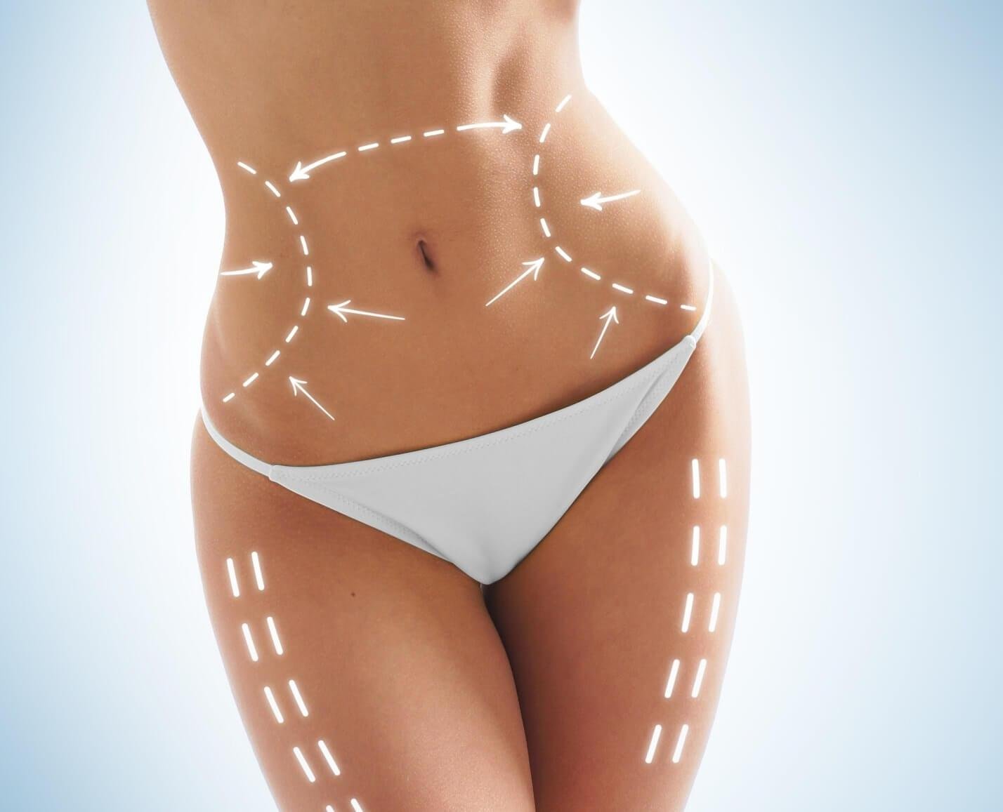 Non-surgical Body lifting