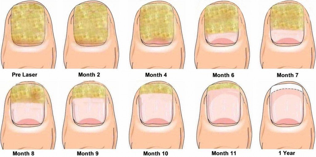 Laser and surgical removal methods for toenail fungus
