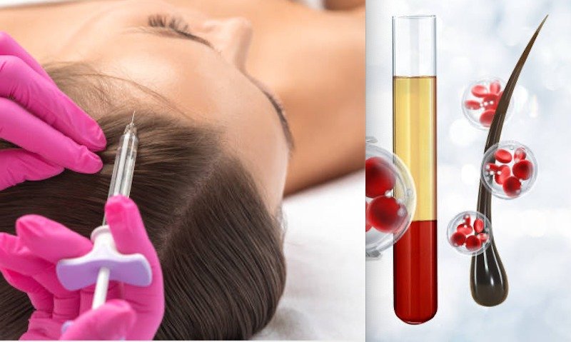 Micro-needling placental growth factor (PRP) hair loss treatment.