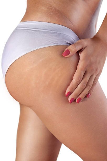 appearance of stretch marks