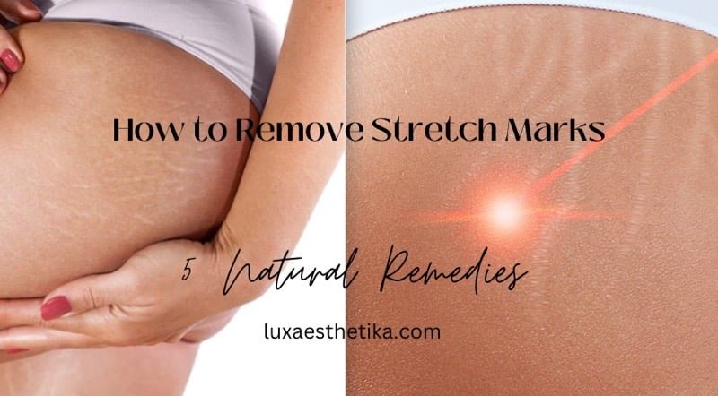 Removal Stretch Marks