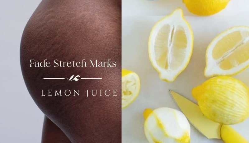 Lemon Juice: The Natural Bleaching Agent Stretch Marks removal