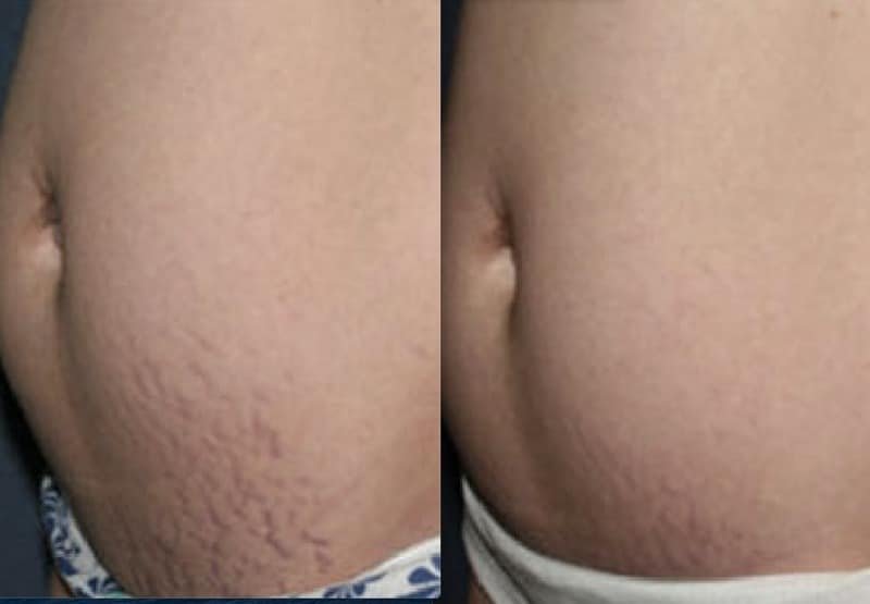 stretch marks Befor and After Photo
