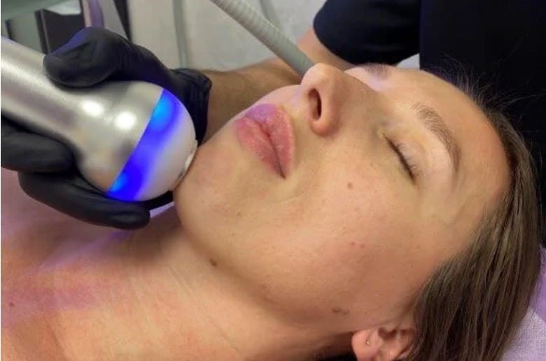 Cryotherapy FaceLifts in Miami PHOTO