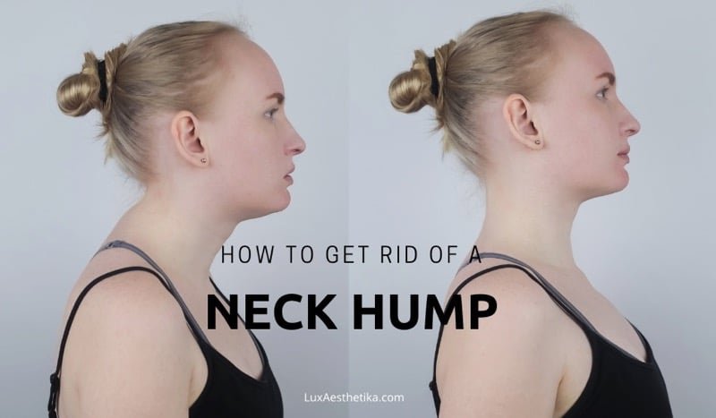 How to get rid of a neck hump